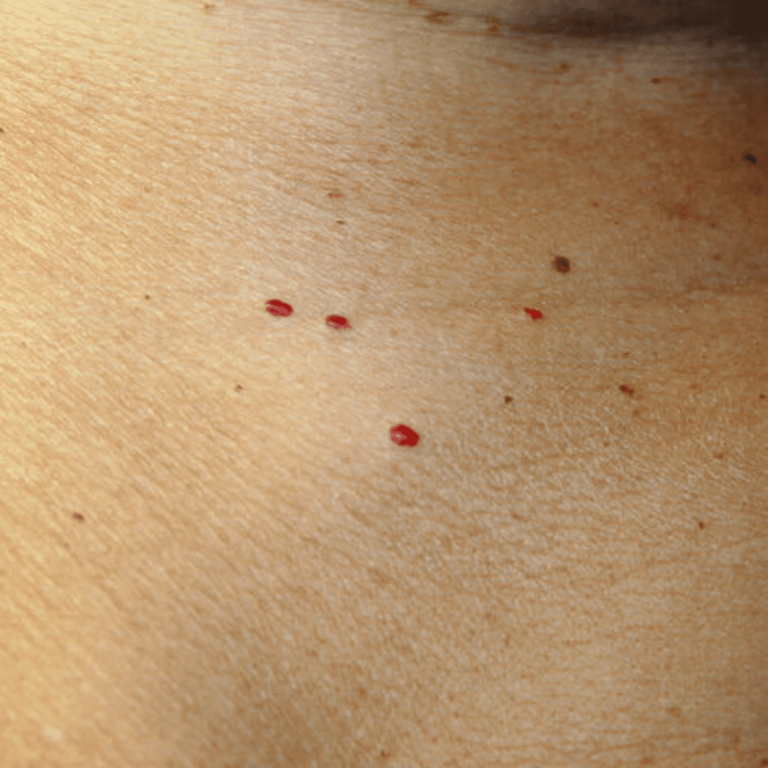 Cluster of red cherry moles on the skin, a treatable concern at River Cottage Beauty Salon in Hamstreet, Kent.