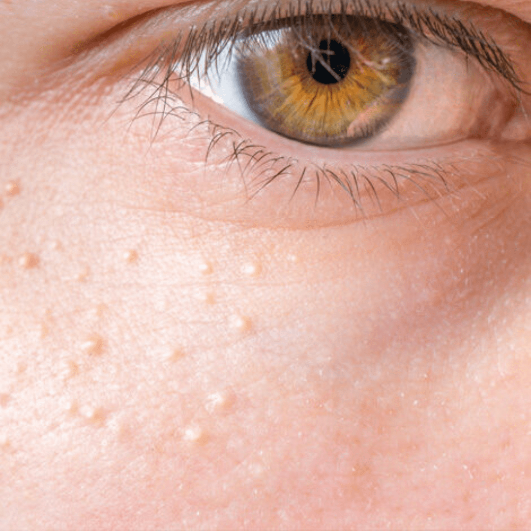 Close-up of milia around the eye area, a common facial concern treated at River Cottage Beauty Salon in Hamstreet, Kent.