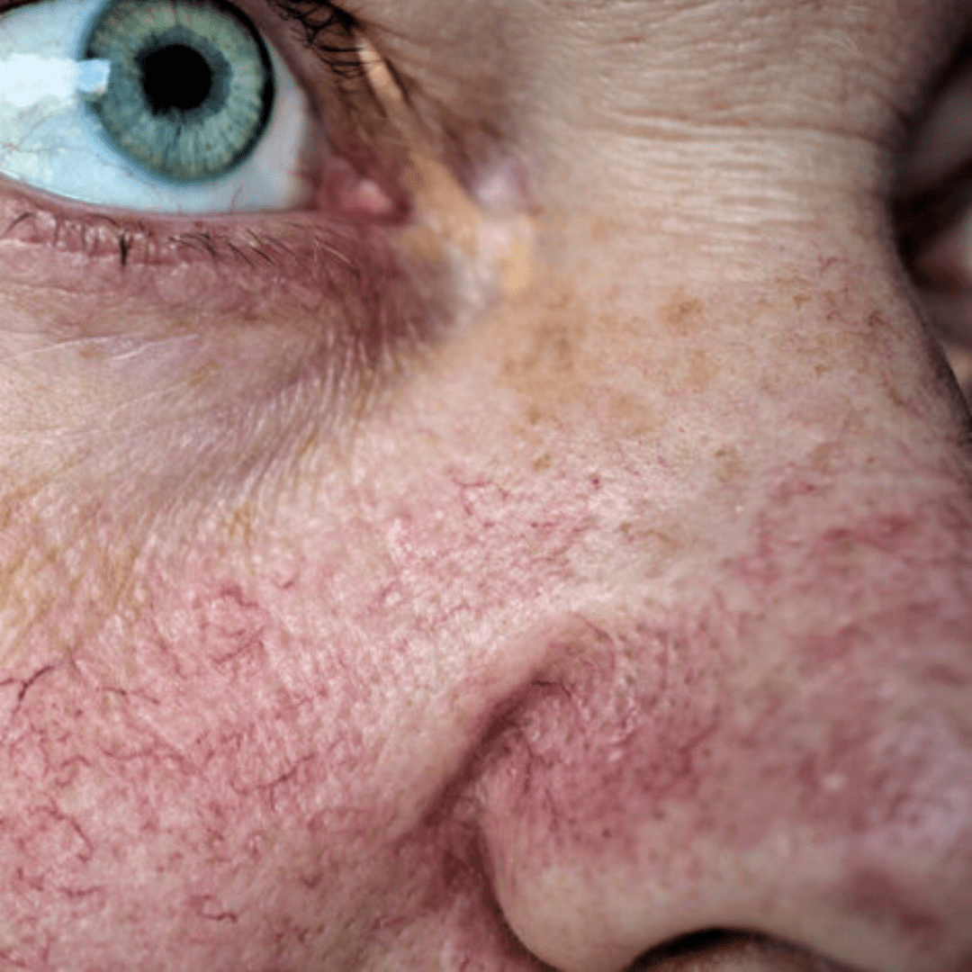 Visible thread veins on the face, representing a common skin concern treated at River Cottage Beauty Salon in Hamstreet, Kent.