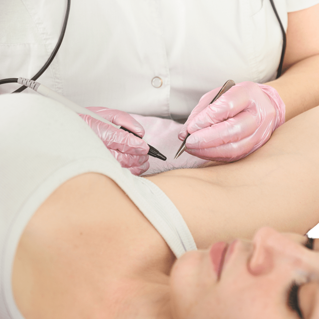 Close-up of electrolysis treatment for blemish removal using a fine probe on a skin tag at River Cottage Beauty Salon in Hamstreet, Kent.