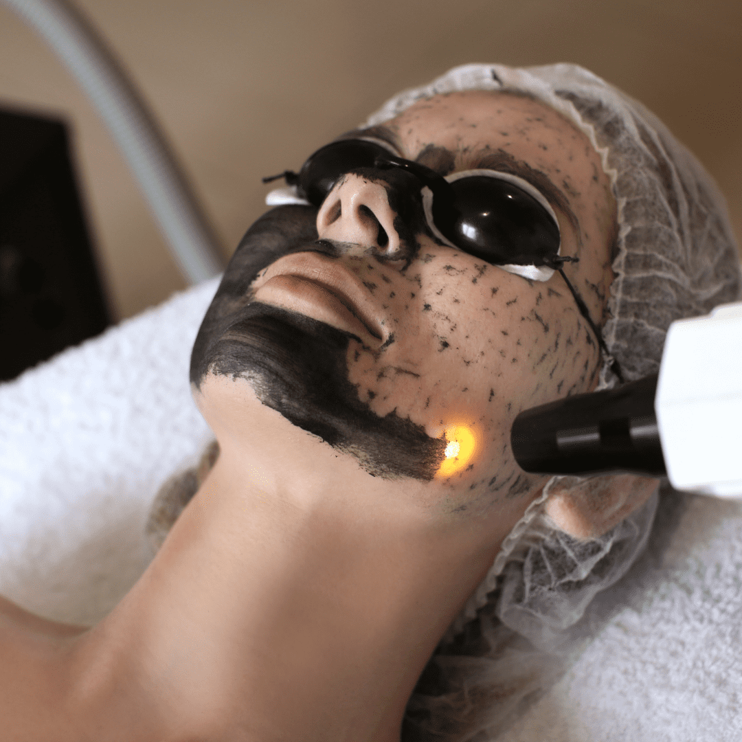 Laser carbon facial treatment, deep-cleansing and resurfacing the skin at River Cottage Beauty Salon in Hamstreet, part of our advanced skin treatments in Kent.