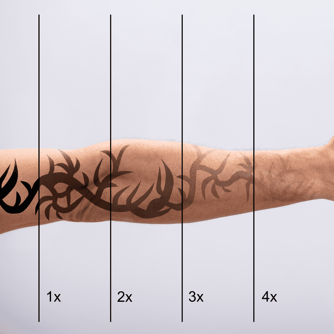 Laser tattoo removal treatment in progress at River Cottage Beauty Salon in Hamstreet, part of our specialist beauty treatments in Kent, targeting unwanted ink for safe and gradual fading.