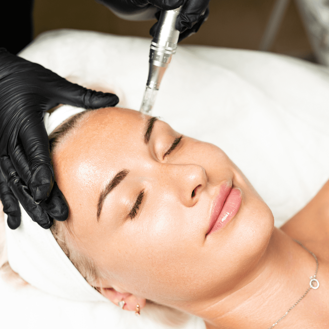 Microneedling treatment creating controlled micro-injuries to stimulate collagen production at River Cottage Beauty Salon in Hamstreet, part of our advanced skin treatments in Kent.