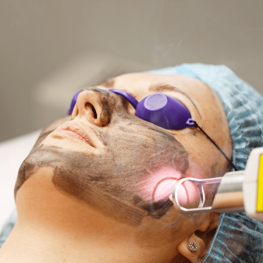 Carbon laser facial in progress for deep skin cleansing at River Cottage Beauty Salon in Hamstreet, part of our advanced skin treatments in Kent.