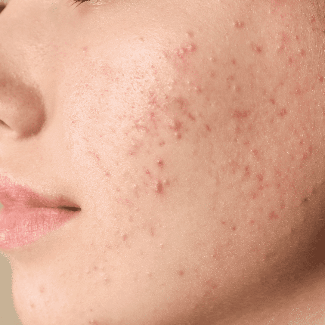 Inflamed acne on the face, a skin concern treated with advanced laser therapy at River Cottage Beauty Salon in Hamstreet, Kent.