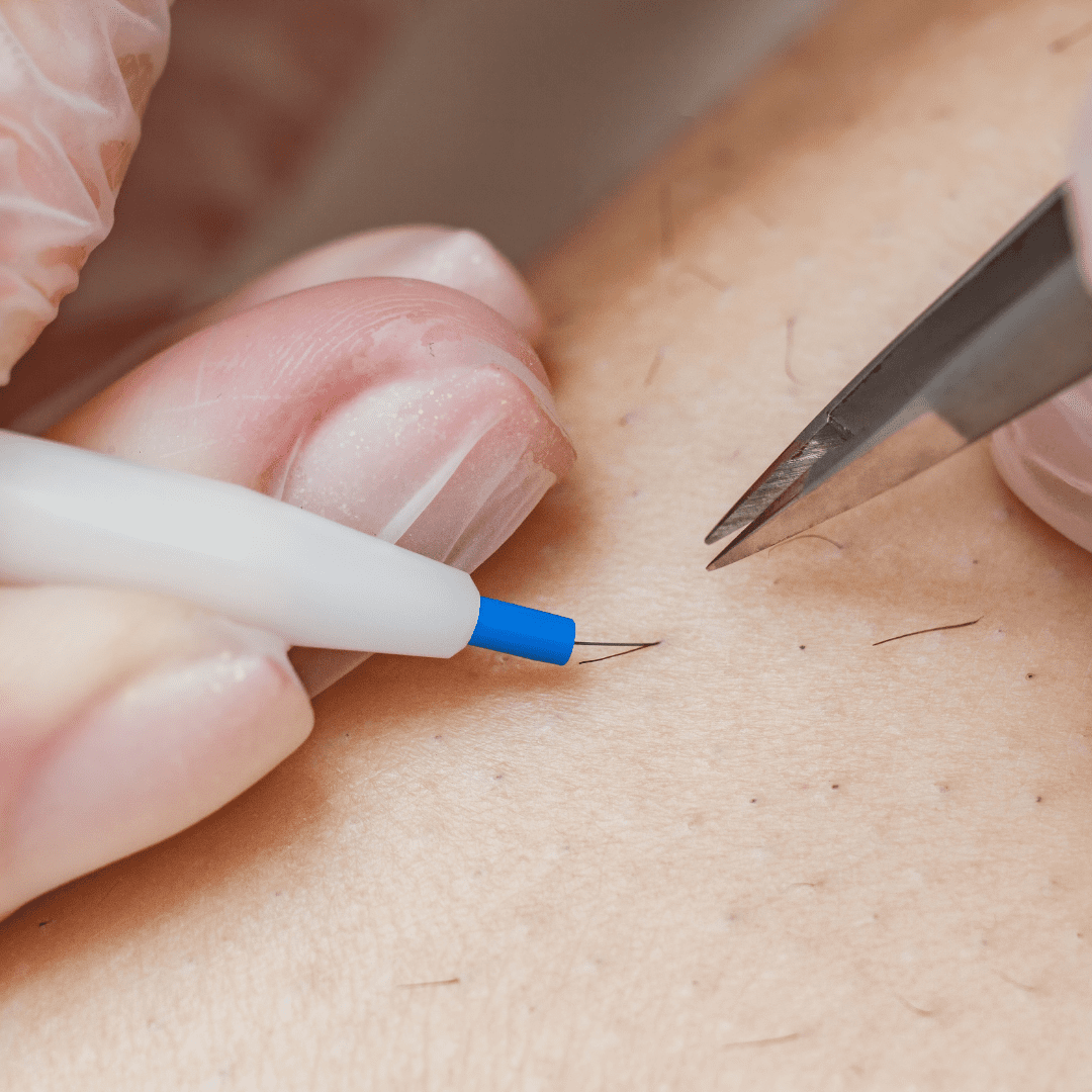 Electrolysis hair removal targeting a single follicle at River Cottage Beauty Salon in Hamstreet, part of our specialist hair removal Kent treatments.