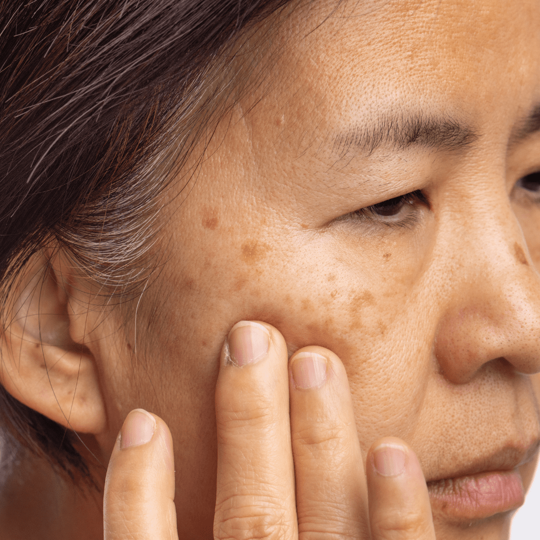 Uneven skin tone and dark spots on the face, treated with pigmentation removal therapies at River Cottage Beauty Salon in Hamstreet, Kent.