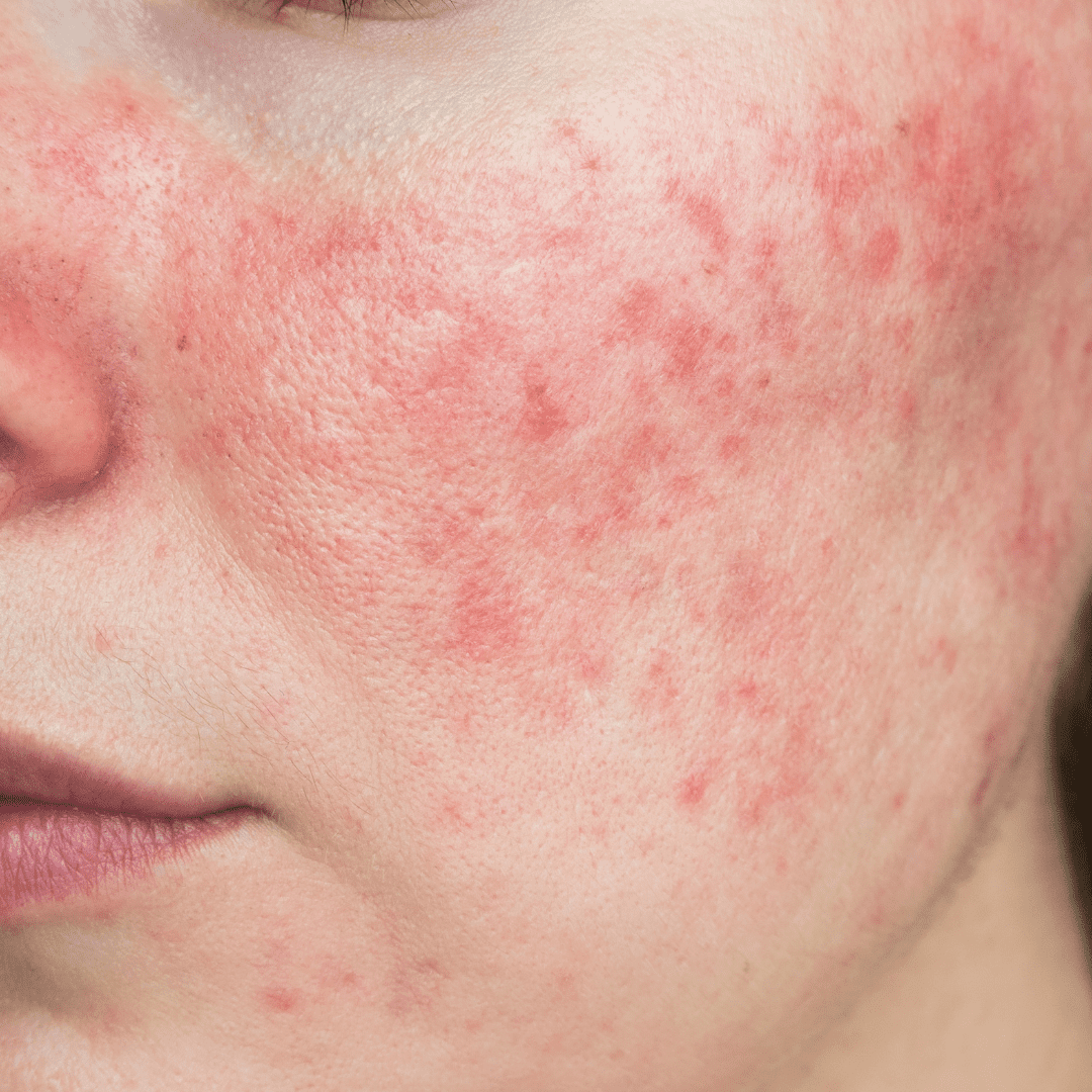 Visible rosacea on the cheeks, a common skin condition treated at River Cottage Beauty Salon in Hamstreet, Kent.