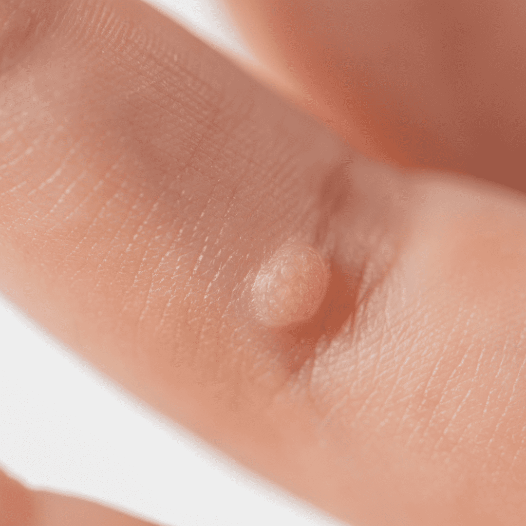 Wart on the finger, one of the skin imperfections treated with cryotherapy at River Cottage Beauty Salon in Hamstreet, Kent.